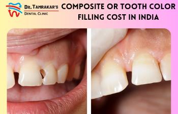 Teeth Colour Or Composite Filling Cost In India
