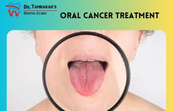 Oral Cancer Treatment
