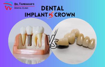 Dental Implant Vs. Dental Crown